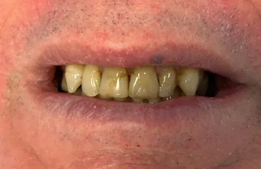 Voor de behandeling Facings